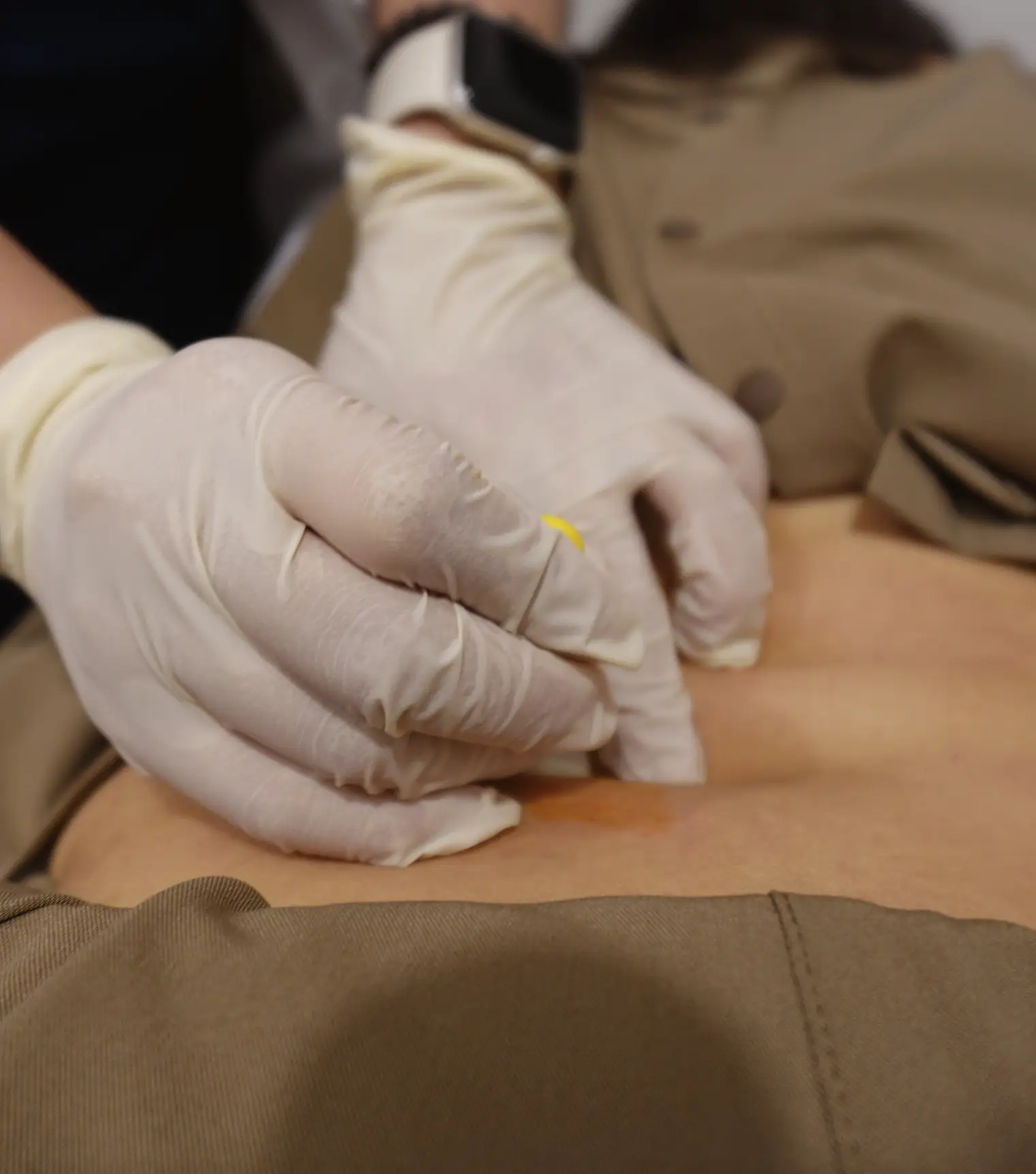 Close-up of acupuncture and Pharmacopuncture on the back