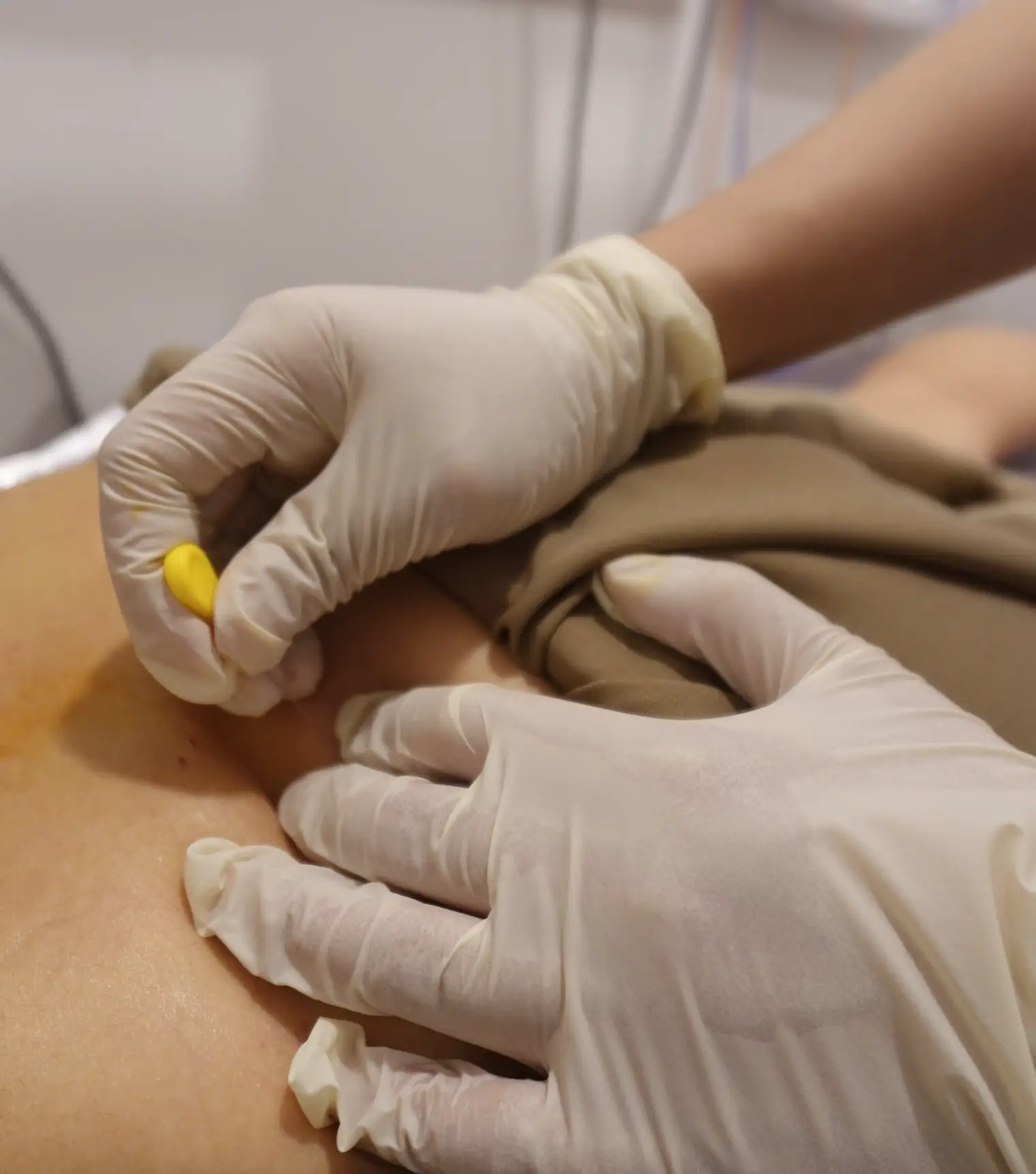 Pharmacopuncture being applied to the arm