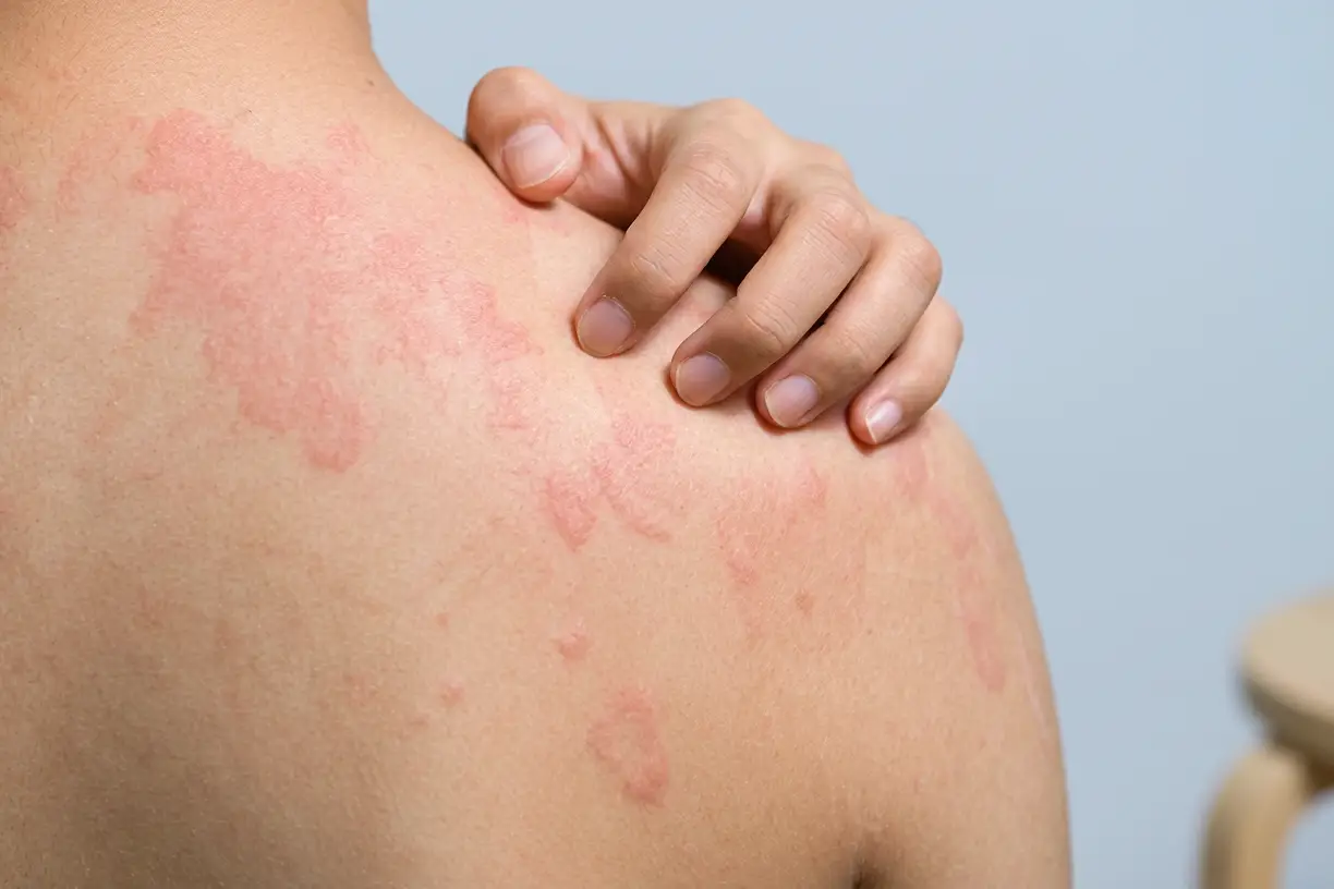 Red hives on the shoulder and back